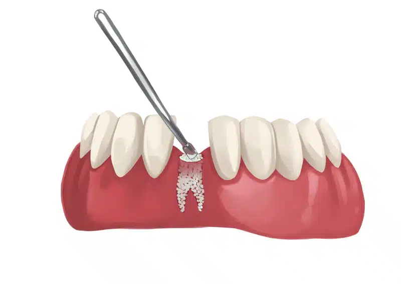 What is a dental bone graft?