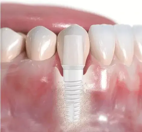 Ceramic implant