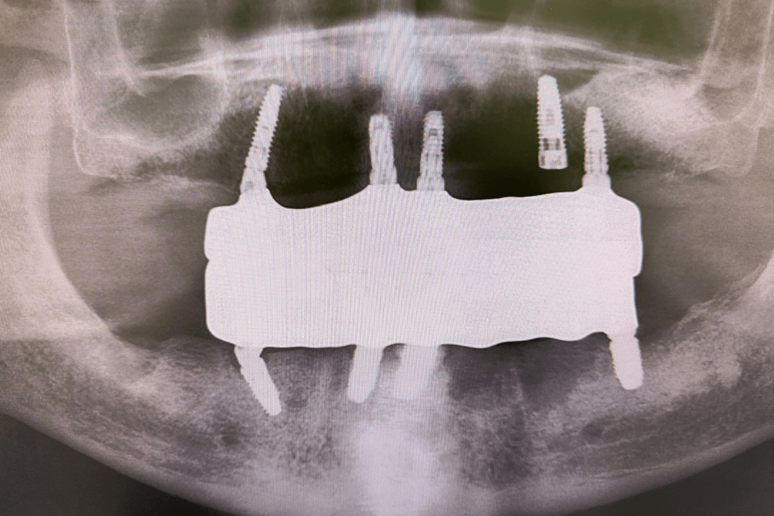 Dr Andrew - 11 Upper & Lower Implant Xray
