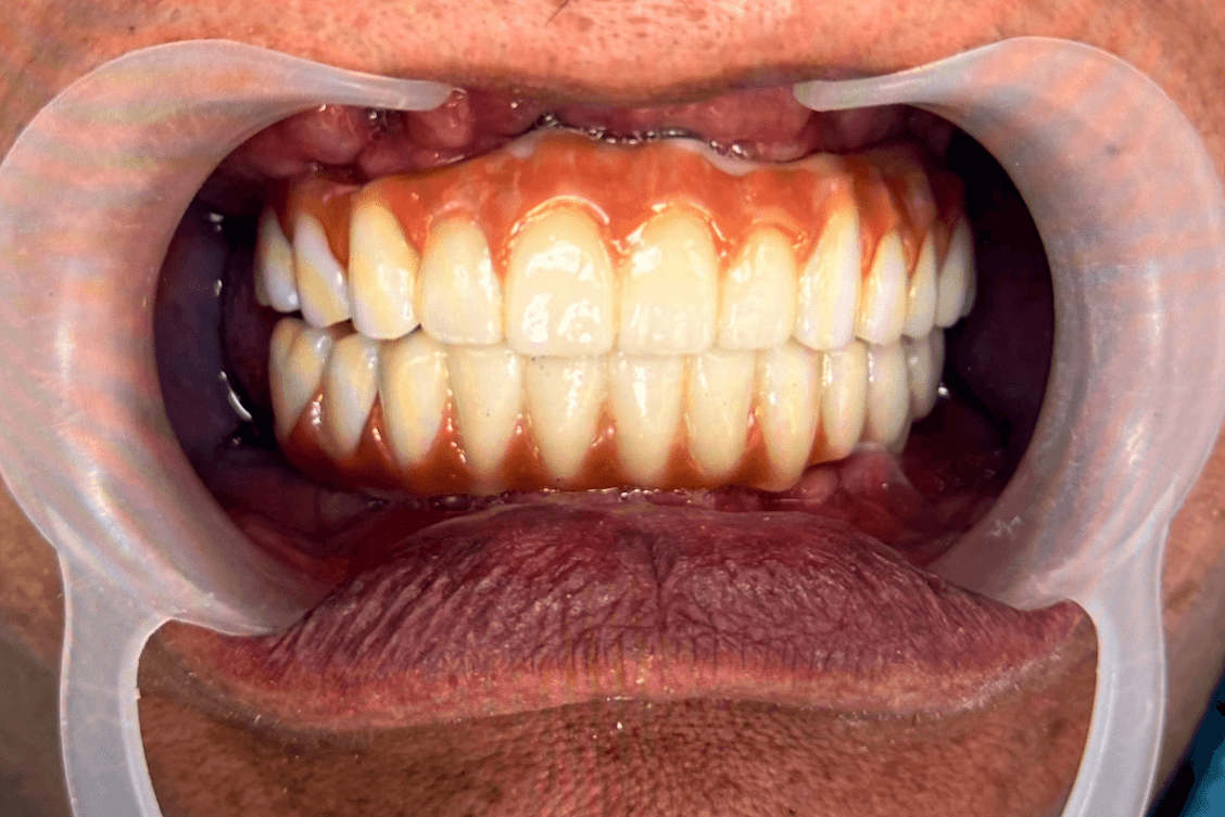 Dr Andrew - 11 Upper & Lower Implant