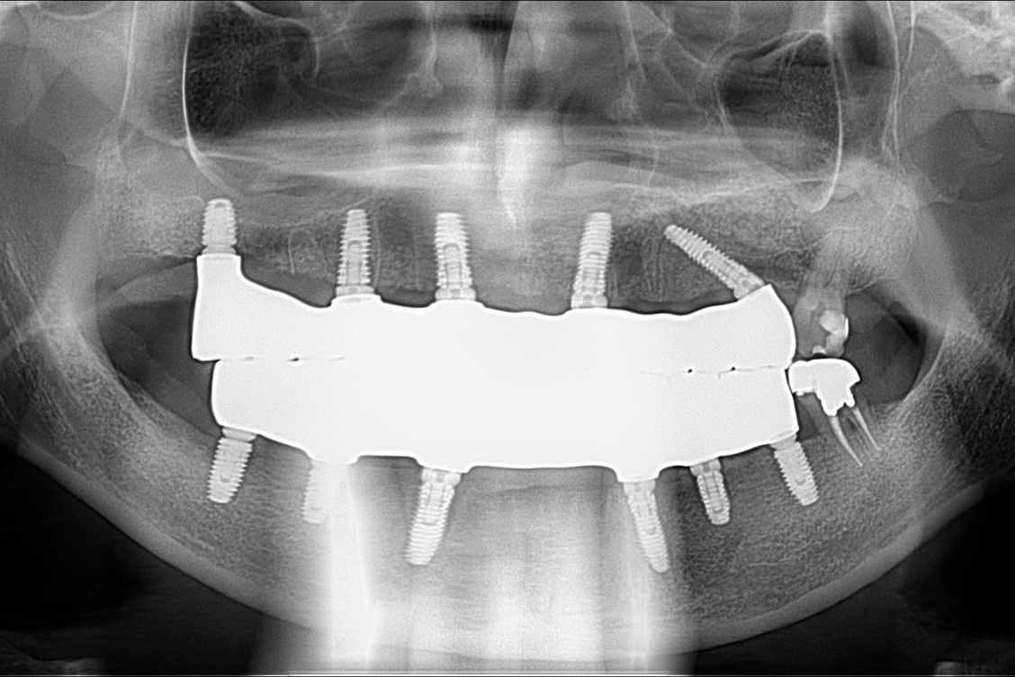 Panoramic dental X-ray showing full arch implants placed in upper and lower jaw after complete reconstruction