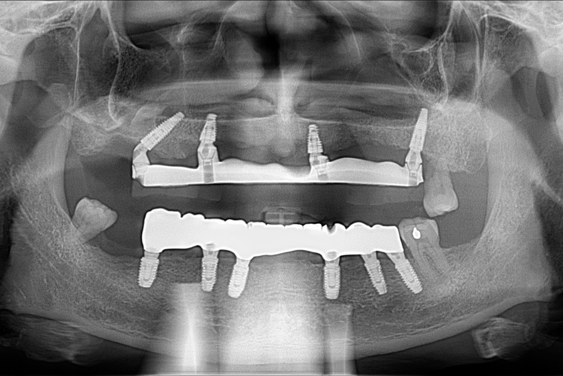 Full mouth dental implant reconstruction restoring bite function and aesthetics after severe tooth loss