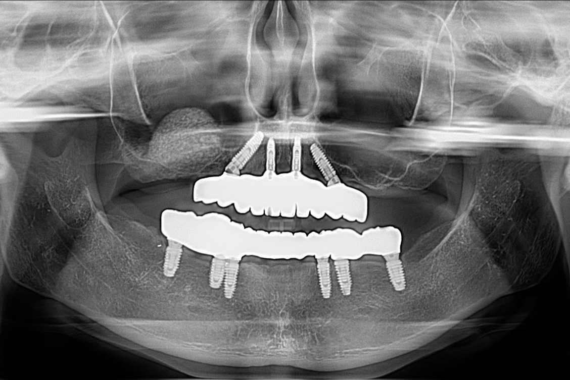 Panoramic dental X-ray showing full arch implant reconstruction supporting fixed prosthesis in upper and lower jaw