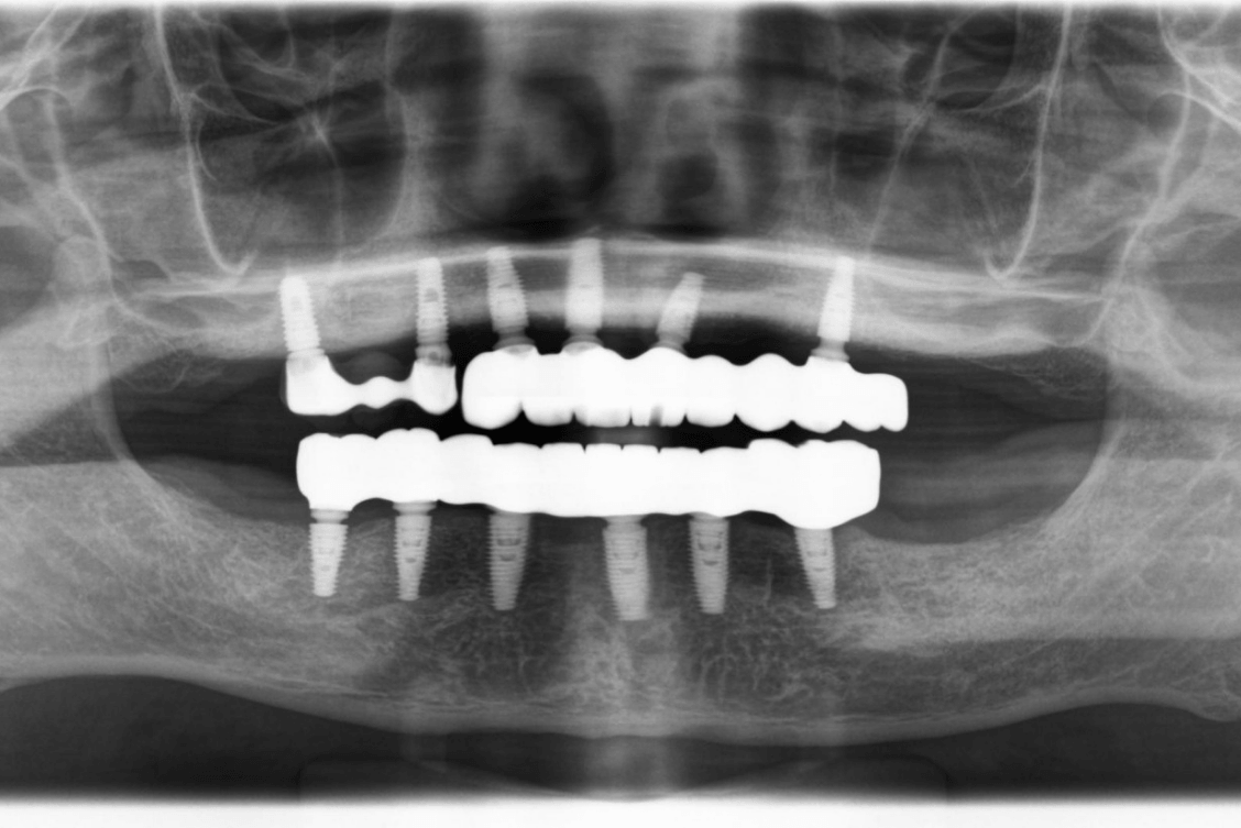 Full mouth dental implant reconstruction showing fixed upper and lower teeth after severe gum disease and tooth loss