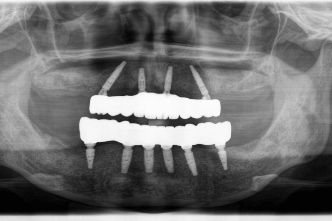 Panoramic dental X-ray showing full arch dental implants in upper and lower jaw after complete tooth replacement
