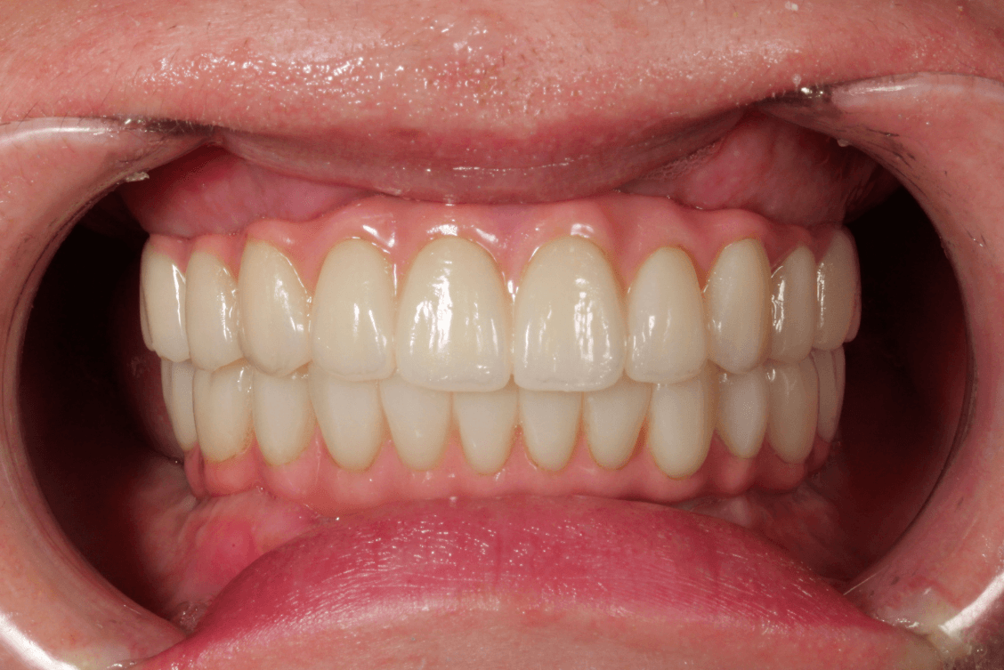 Full mouth dental implant reconstruction showing upper and lower fixed teeth after severe gum disease and tooth loss