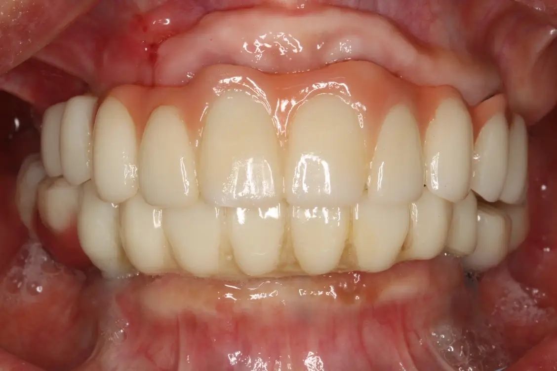 Full mouth dental implant restoration showing natural-looking fixed teeth after severe tooth wear and grinding damage