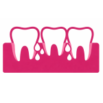 pus in teeth_gums