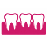 receding gums